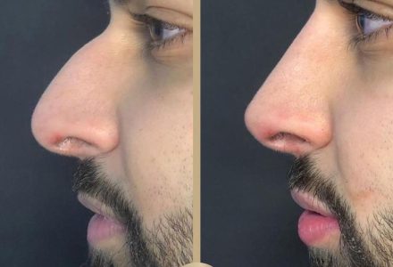 How Much Does a Non-Surgical Nose Job Cost? 
