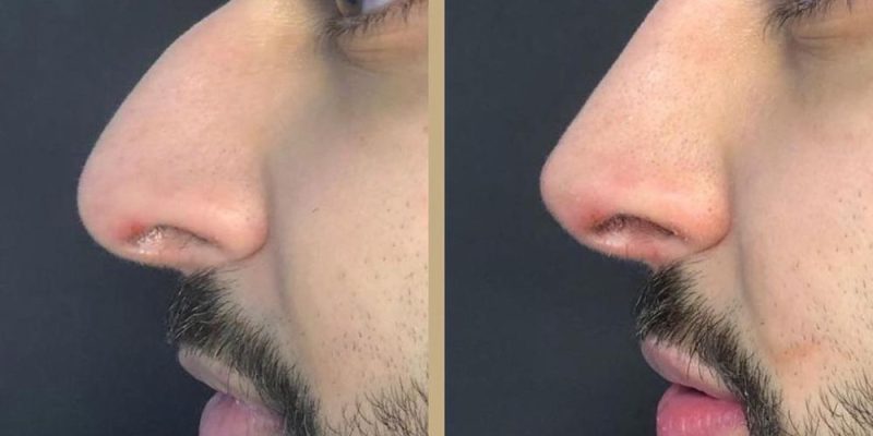 How Much Does a Non-Surgical Nose Job Cost? 