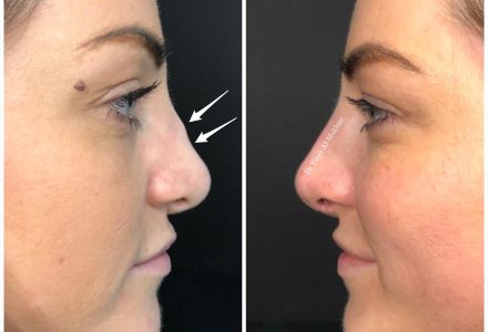 Non Surgical Rhinoplasty