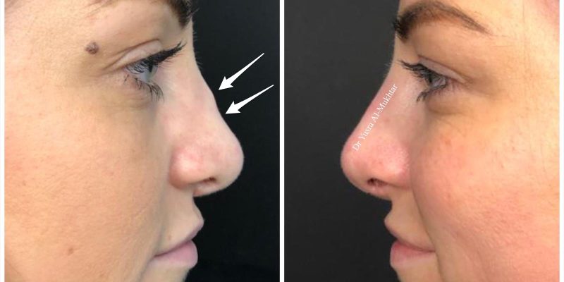 Non Surgical Rhinoplasty
