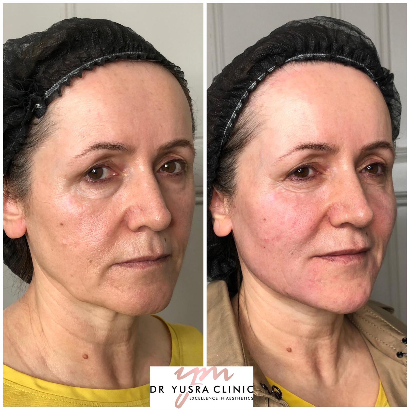 Sagging Jowls Dr Yusra