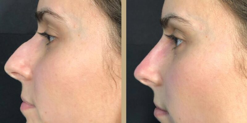 Non-Surgical Rhinoplasty, Nose Dermal Fillers