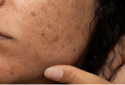 Sun damage Sun Damage Recovery