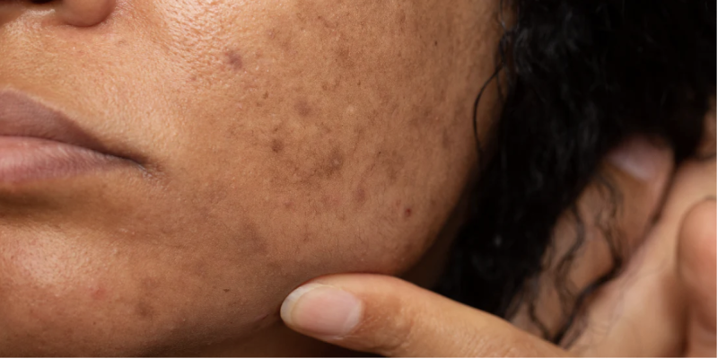 Sun damage Sun Damage Recovery