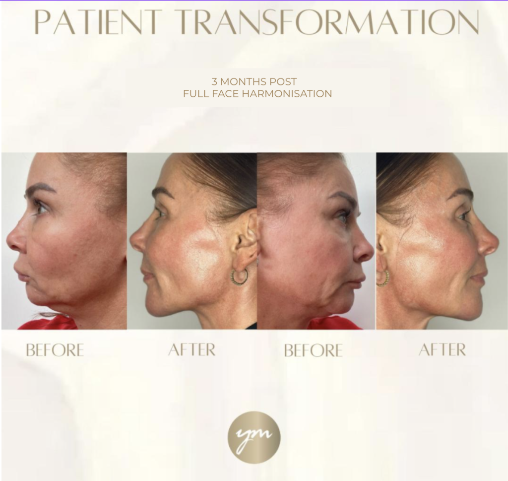 Full Face Harmonisation