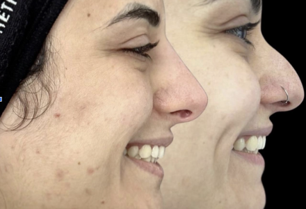 Non-Surgical Rhinoplasty