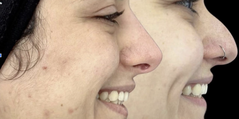 Non-Surgical Rhinoplasty