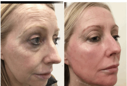 SkinBoosters