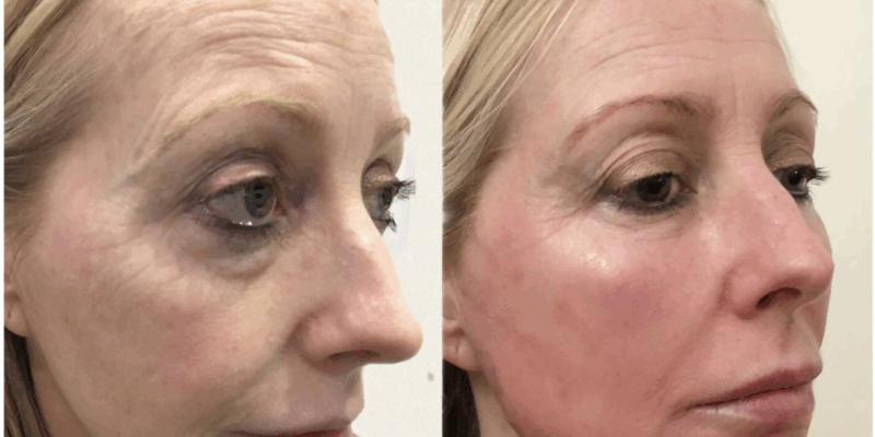 SkinBoosters