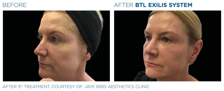 Before after after BTL Exilis 360 radio frequency device