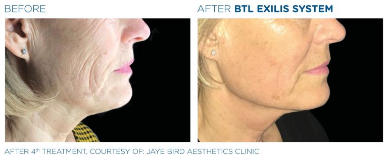 Before after after BTL Exilis 360 radio frequency device