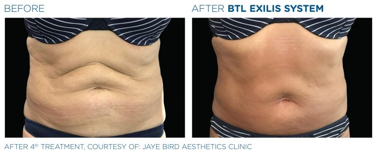 Before after after BTL Exilis 360 radio frequency device