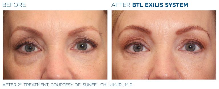 Before after after BTL Exilis 360 radio frequency device