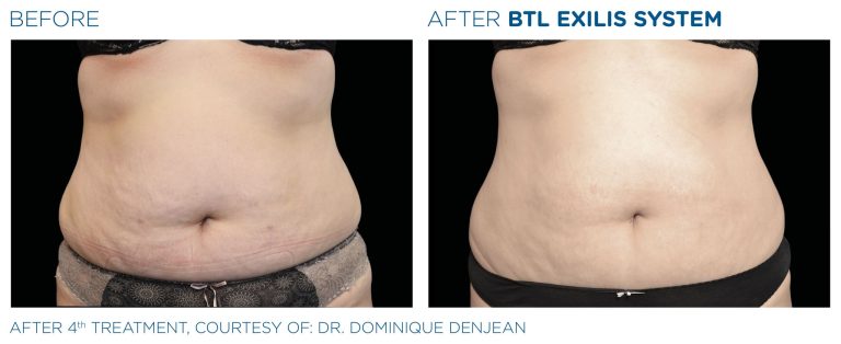 Before after after BTL Exilis 360 radio frequency device