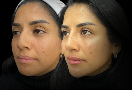 full face laser and filler results in London