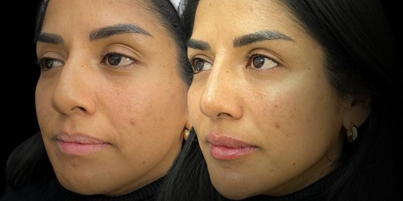 full face laser and filler results in London
