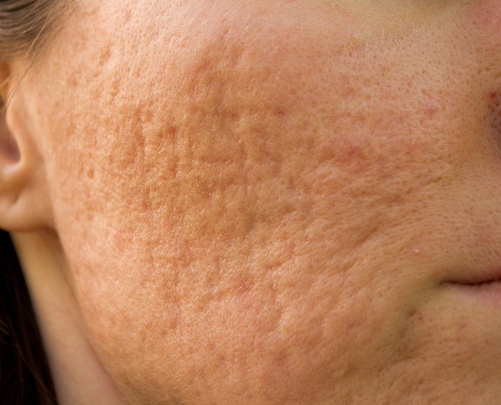 Treatments for Acne Scarring Natural Treatments Dr Yusra