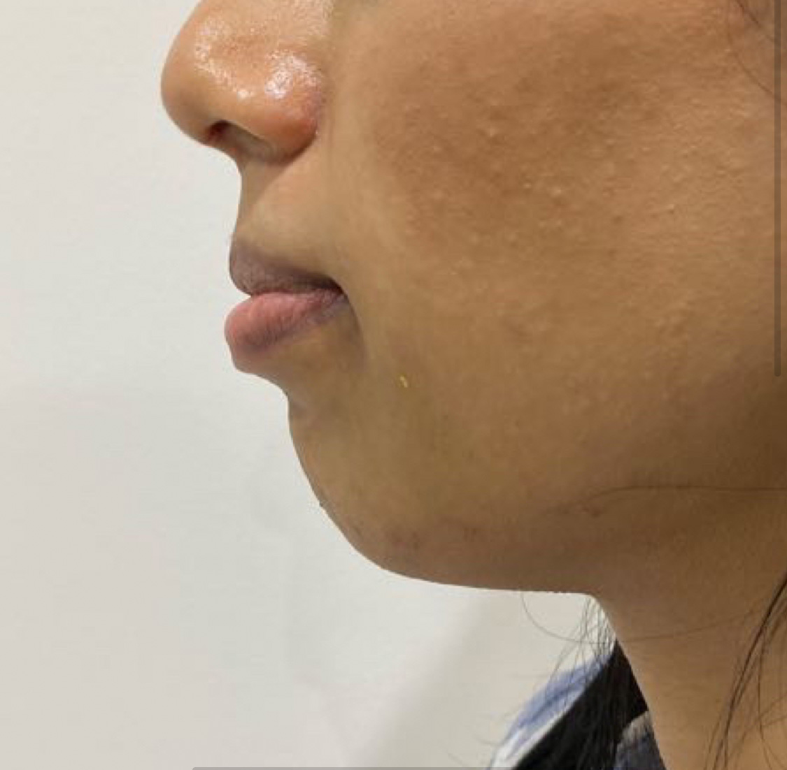 Jawline Definition Treatments Facial Sculpting Dr Yusra