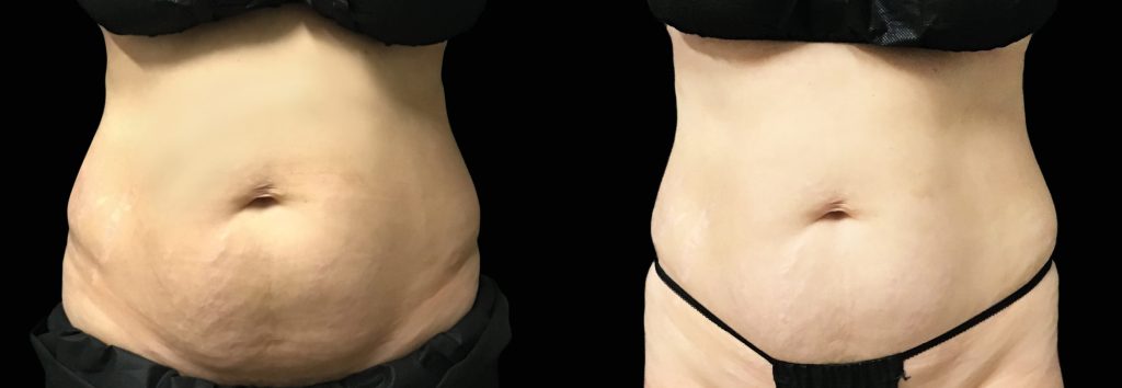 How EmSculpt NEO can help improve Diastasis Recti