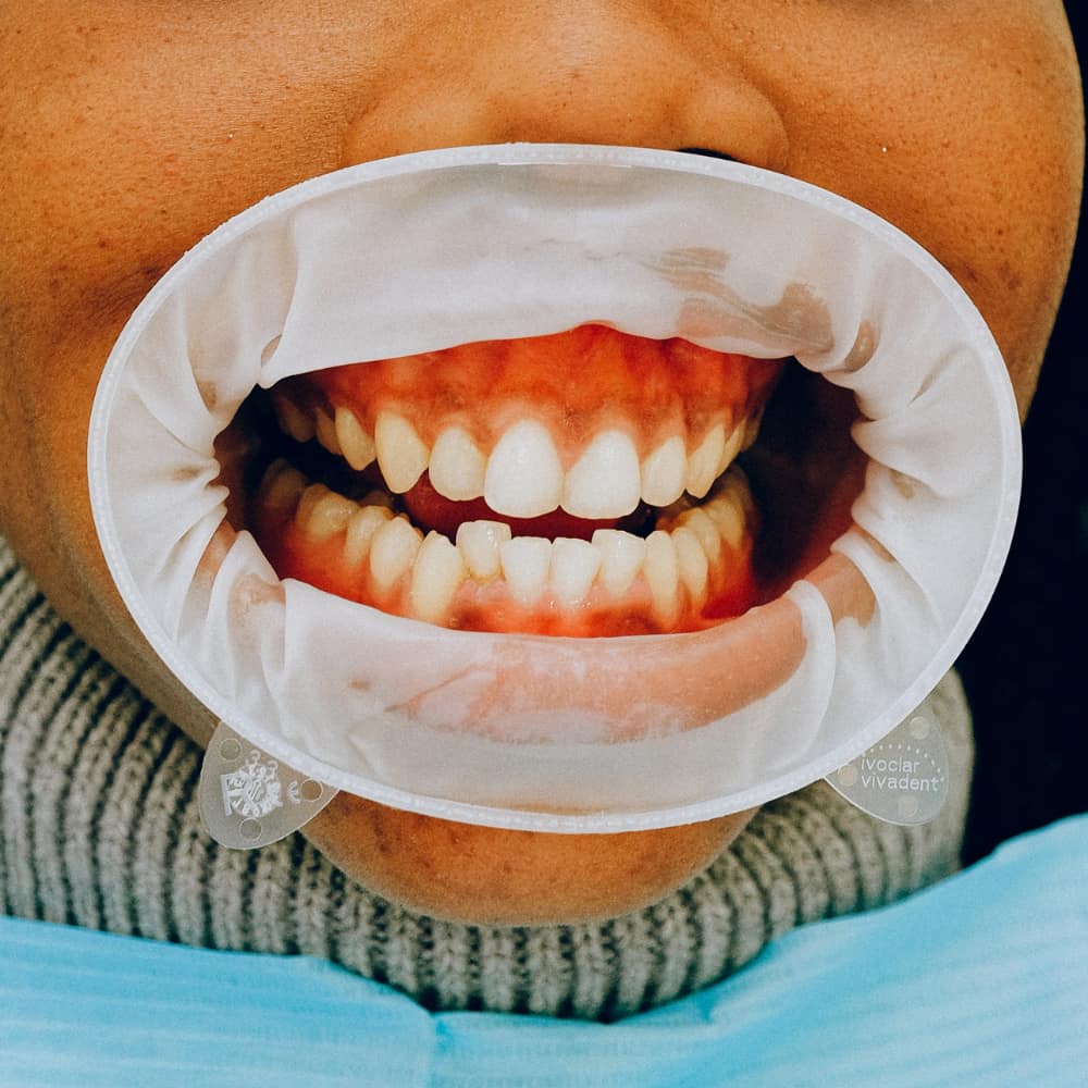 Who Are Inman Aligners For?